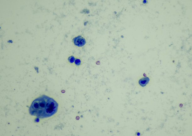 泌尿道上皮癌，高级别图片下载