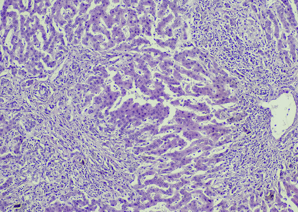 原发性胆汁性肝硬化图片下载