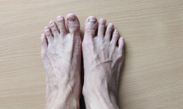 照片显示的皮炎炎症的赤脚图片下载