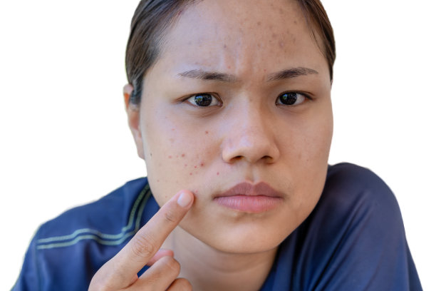 近距离的年轻亚洲妇女担心她的脸，当她有问题的皮肤在她的脸。痤疮和疤痕的问题在女性皮肤孤立的白底。问题护肤健康理念。图片下载