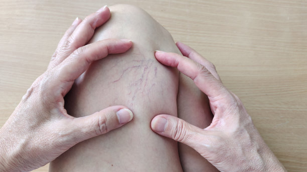 那个女人腿上的静脉曲张。图片下载