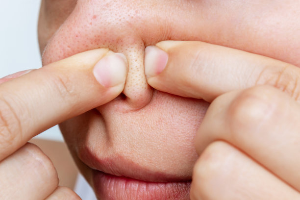 年轻女子用手指挤出黑头或粉刺的特写。痤疮的问题图片下载