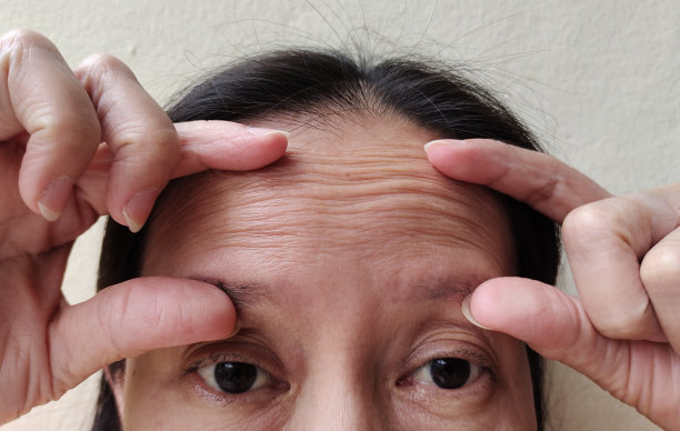 前额皱纹松弛图片下载