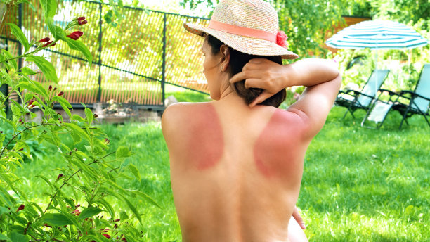 晒伤女孩的后背。皮肤晒伤是因为没有使用有防晒保护的面霜。这名妇女的皮肤因为没有使用防晒系数(SPF)的防晒产品而被晒伤。图片下载