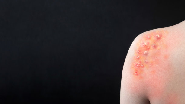 猴痘。皮肤因猴痘而起了水泡。病毒流行疾病。黑色背景。图片下载
