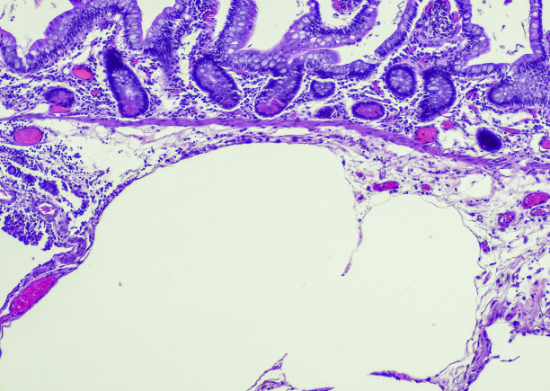 积气囊状的intestinalis。摘要肠囊病(PCI)是一种罕见的疾病，其特征是肠壁存在含有氮、氢和二氧化碳的气态囊肿，可能是医源性或与之相关图片下载