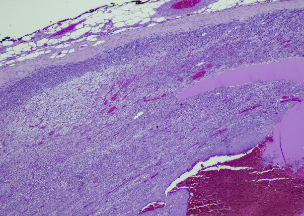 肾上腺皮质癌图片下载