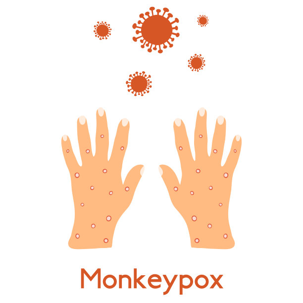 猴痘症状，手部皮疹，水泡和化脓形成。由一种病毒引起的皮肤病，水痘，痤疮，在白色背景上孤立的扁平型脓疱图片下载