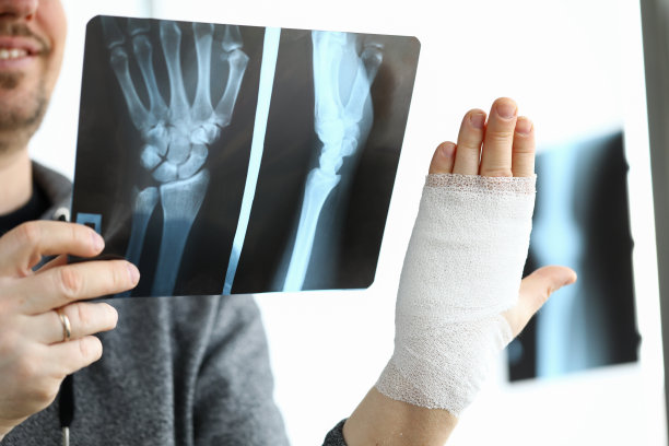 男性患者手持骨折手臂的CT扫描图片下载