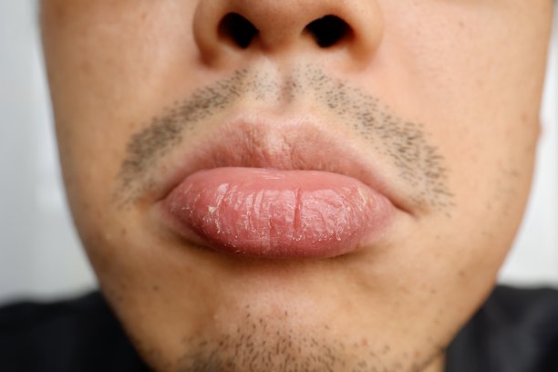 干燥的嘴唇图片下载