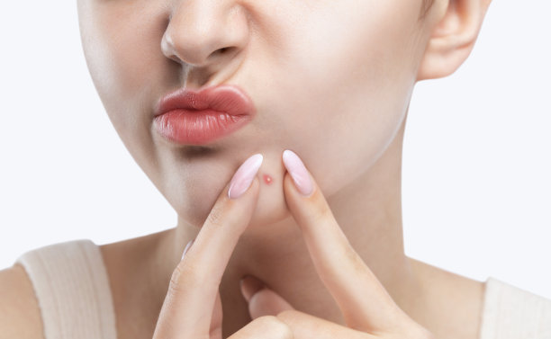 一个脸上皮肤有问题的年轻女孩。那女孩捏着下巴上的一个痘痘。图片下载