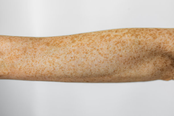 雀斑在手臂图片下载