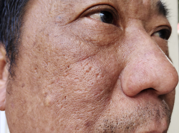 男性患者面部松弛的脂肪、皱纹和斑点图片下载