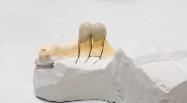 从陶瓷牙图片下载