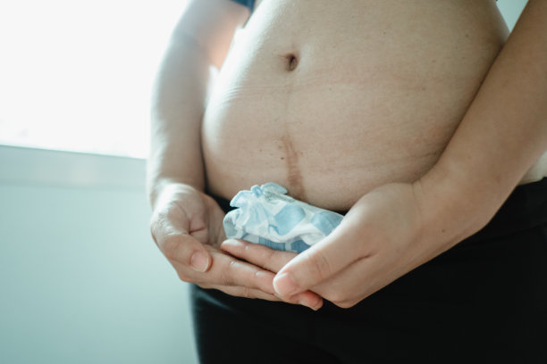 剖腹产疤痕的女性腹部特写图片下载