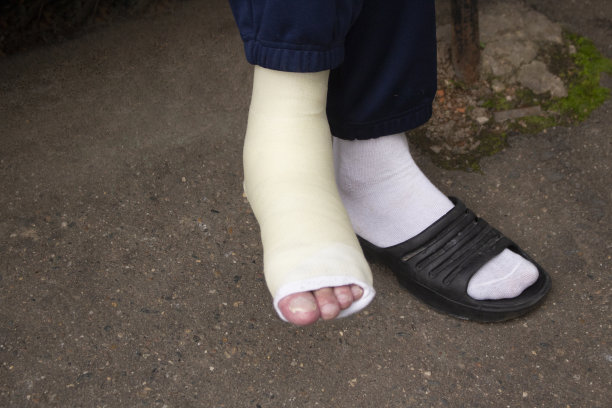 腿打了石膏。肢体损伤。人类的腿。石膏步行。图片下载