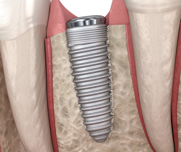 种植体附近有新骨生长。医学精准的3D插画。图片下载