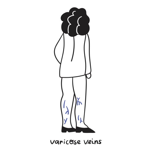 女人有静脉曲张。图片下载