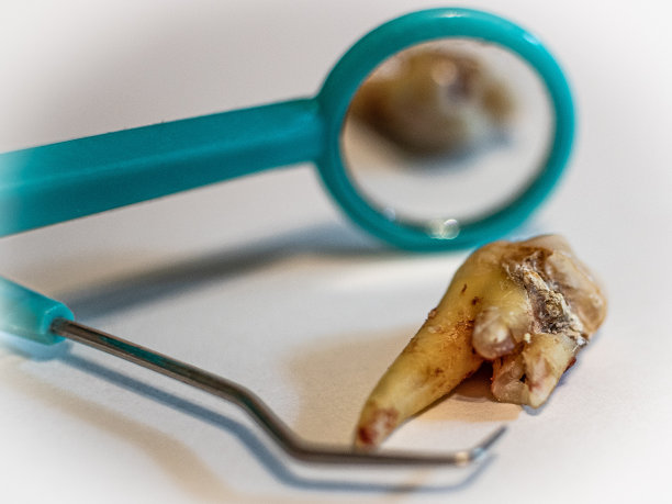 牙科衰变图片下载