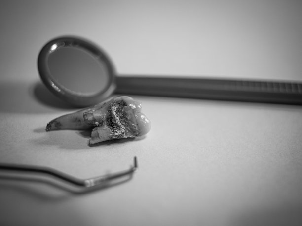 牙科衰变图片下载