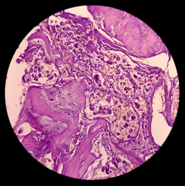 骶骨SOL，脊索瘤显微照片。显示软组织和骨性组织、恶性肿瘤、黏液样细胞间组织、发浆细胞、空泡状细胞质。图片下载