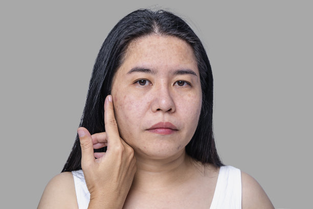 特写亚洲成年女性的脸上有雀斑，毛孔粗大，黑头粉刺和疤痕的问题，因为没有照顾很长时间。皮肤问题面软焦点。治疗和护肤理念图片下载