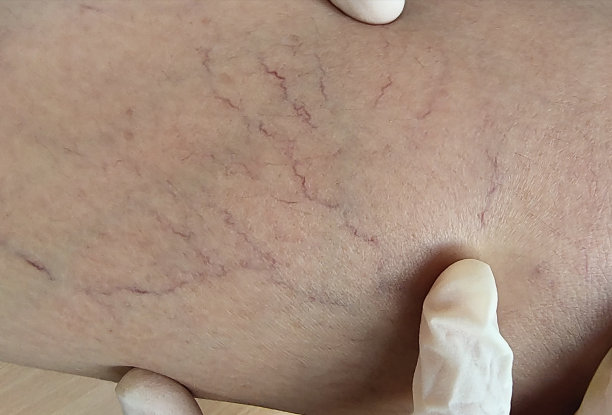 女人腿上的静脉曲张和血蜘蛛图片下载