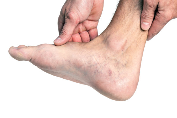 一个男人的脚上有静脉曲张，白色背景图片下载