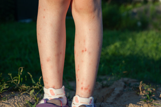 背景是草，被咬得很严重的孩子的脚图片下载