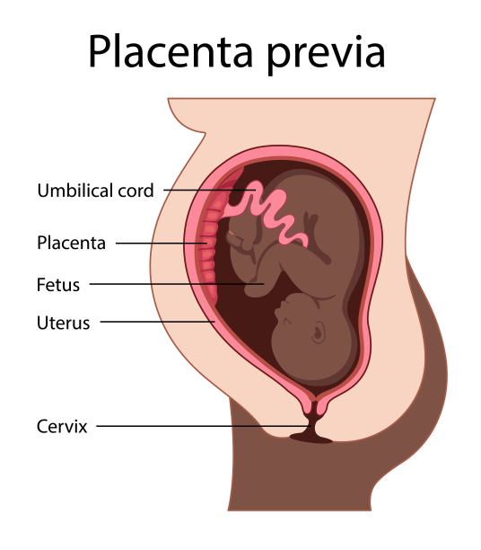 前置胎盘图片下载