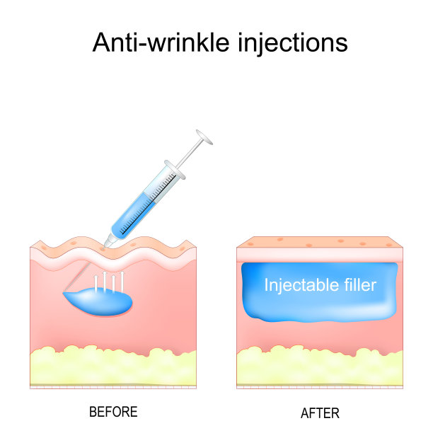 注射除皱。审美的过程。图片下载