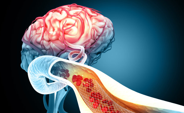 动脉粥样硬化中风。血凝块人脑血管中的血块三维演示图片下载