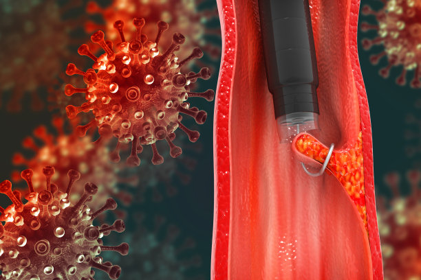结肠癌。结肠息肉切除。内窥镜内结肠镜检查结肠息肉。三维演示图片下载