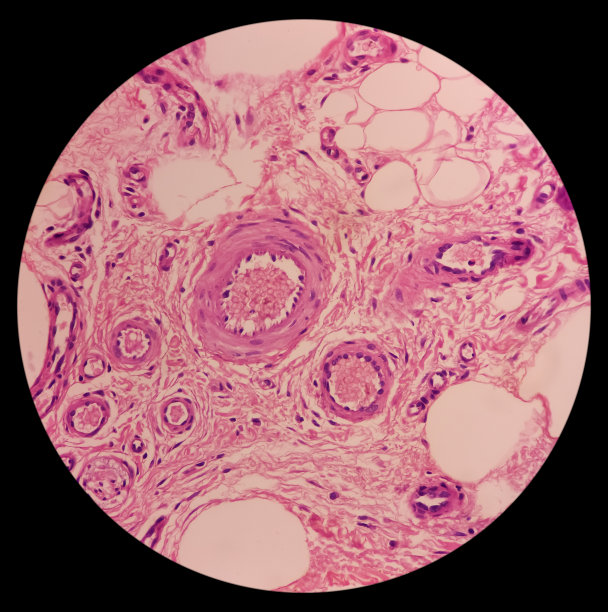 膝关节(活检):神经节细胞，镜下显示囊肿壁由纤维胶原组织组成，内衬扁平上皮。图片下载
