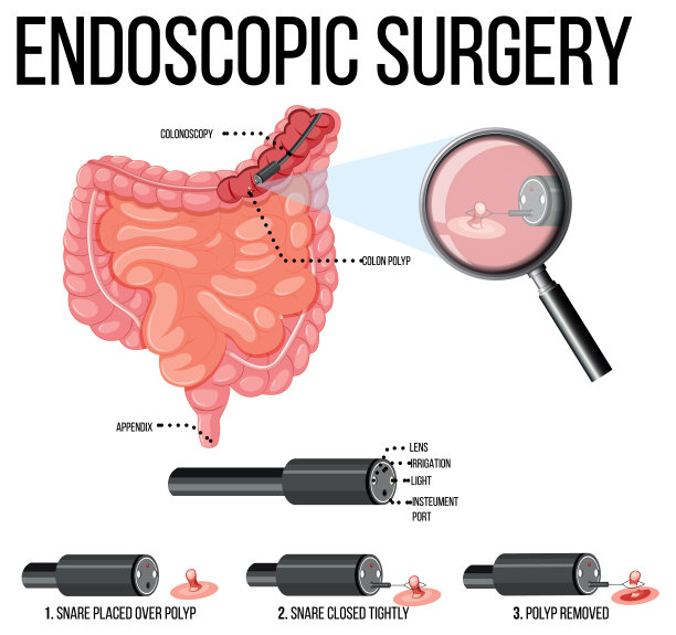 内窥镜手术示意图图片下载