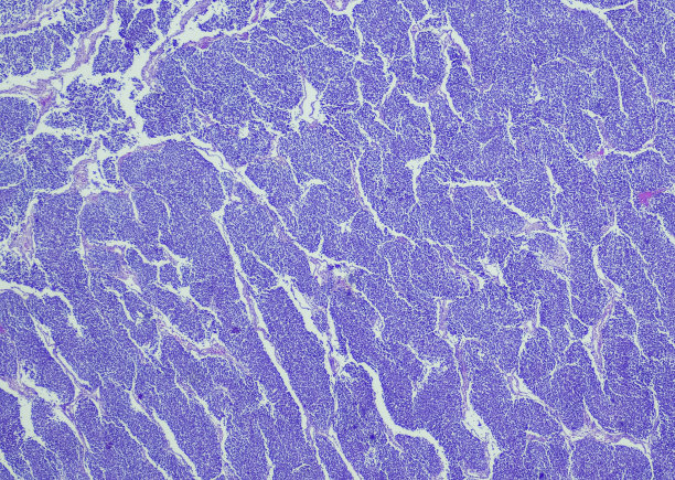 肾母细胞瘤(肾母细胞瘤)，母细胞为主图片下载