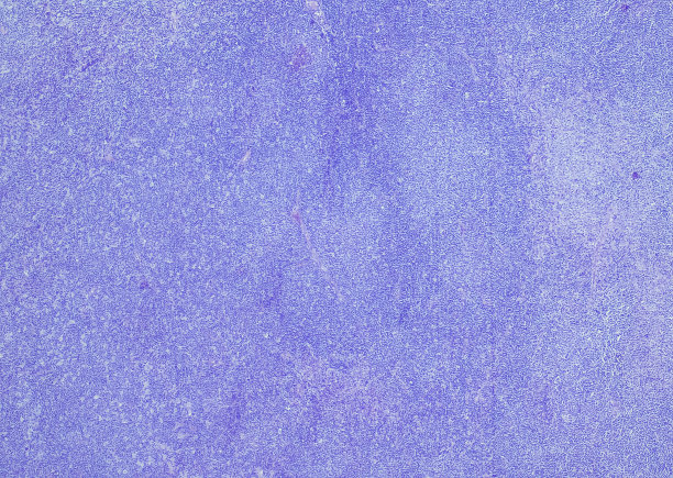 小淋巴细胞淋巴瘤/慢性淋巴细胞白血病图片下载