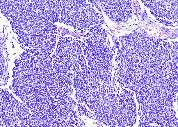 肾母细胞瘤(肾母细胞瘤)，母细胞为主图片下载