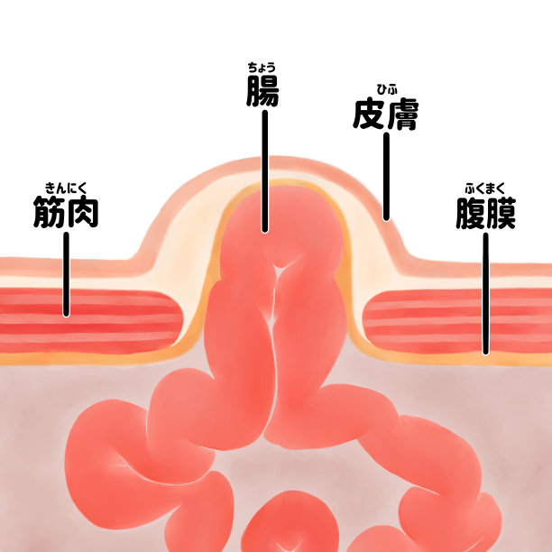 脐疝横切面;日语图片下载