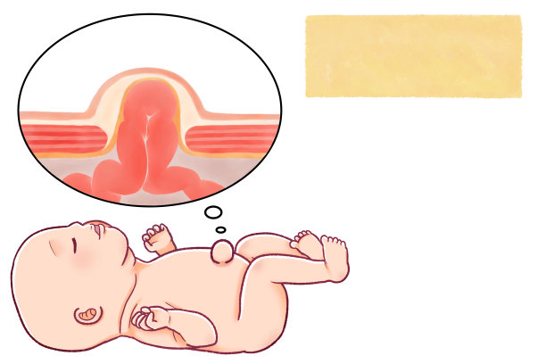 新生儿脐疝的插图图片下载