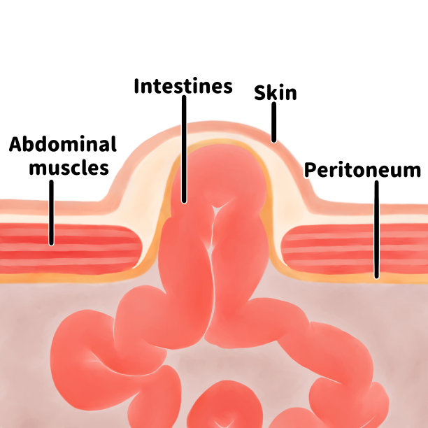 脐疝横切面;英语语言图片下载