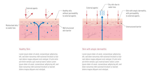 健康皮肤与特应性皮炎皮肤的信息图图片下载