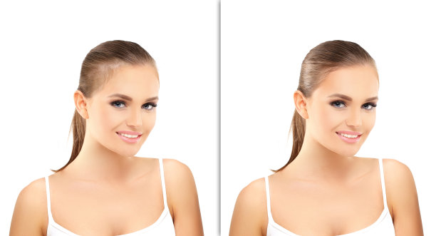 头发稀疏和脱发，女性秃顶，植发图片下载