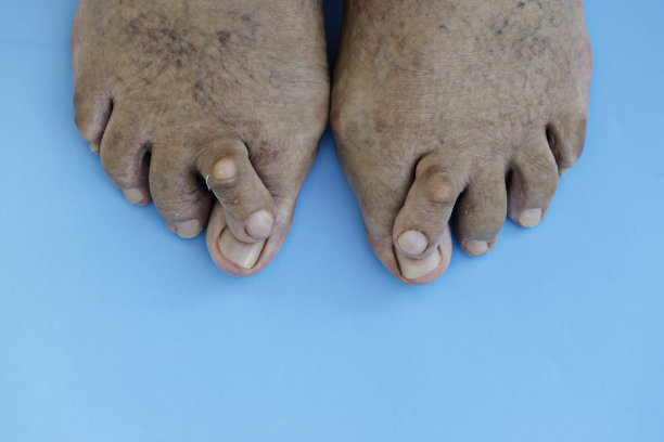 交叉脚趾图片下载