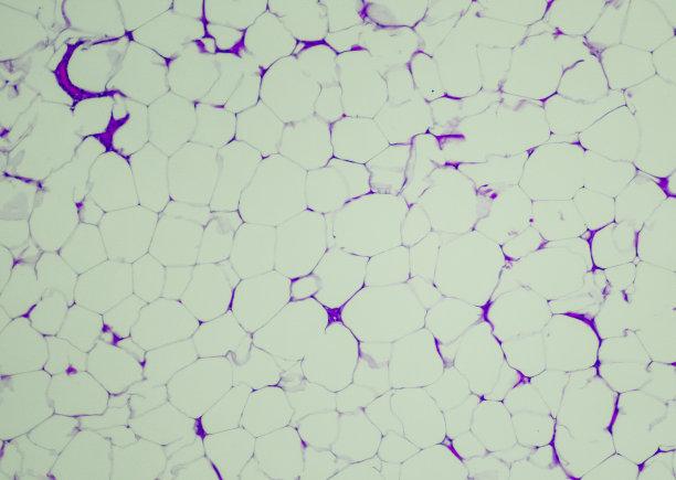 脂肪瘤图片下载