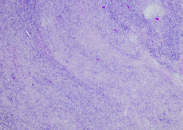 间质分化的化生癌图片下载