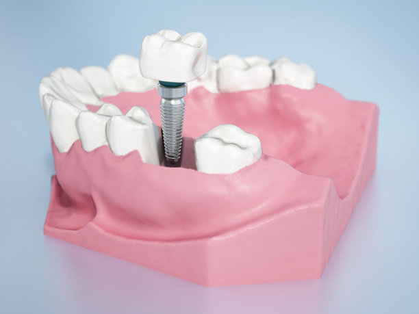 下颌植牙模型图片下载