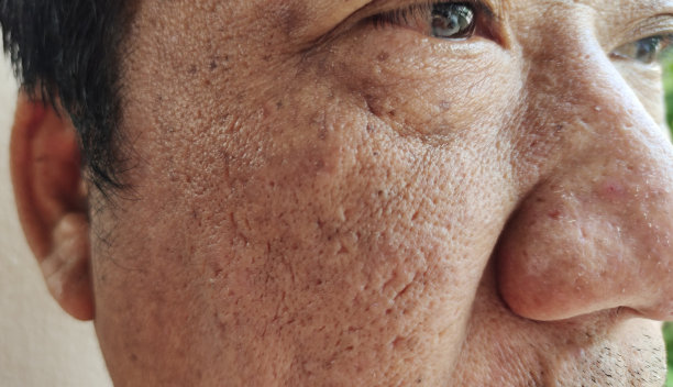 男病人脸上的雀斑和瑕疵，皮肤暗沉和黑斑。图片下载