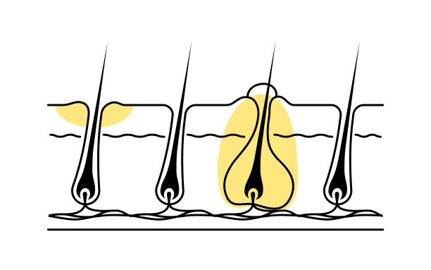 脱毛皮肤问题图像粗糙的皮肤图片下载