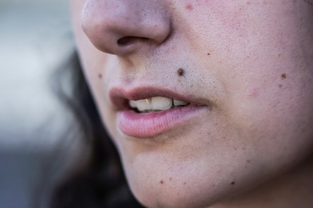 女孩的面部毛发。有很多痣的女人嘴边的小胡子。图片下载